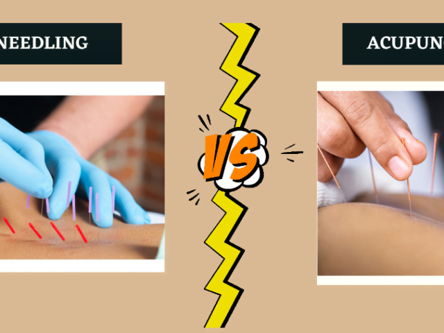 Dry Needling vs. Acupuncture: What’s the Difference?